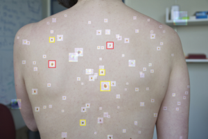 Crean herramienta de IA capaz de detectar melanoma en fase inicial